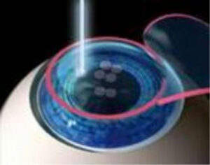 Laser refractive surgery